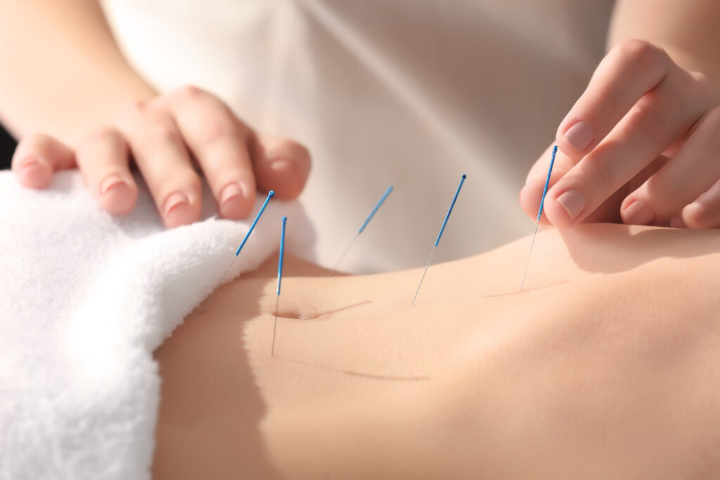 Endometriosis and Acupuncture