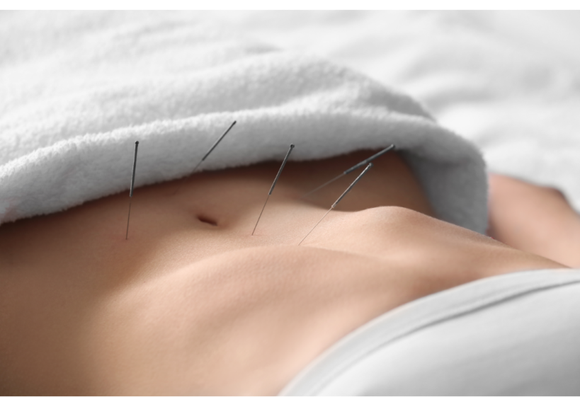 Endometriosis and Acupuncture