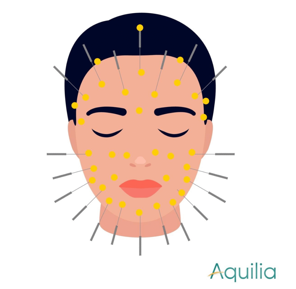 Thinking About Facial Acupuncture? Here’s What to Expect