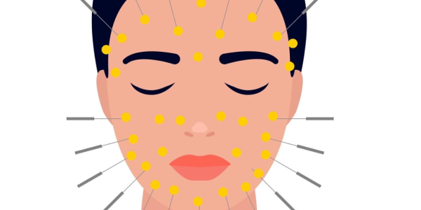 facial acupuncture